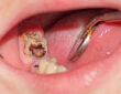 Tooth Decay
