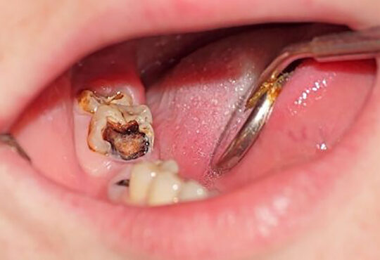 Tooth Decay