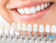 dental veneers