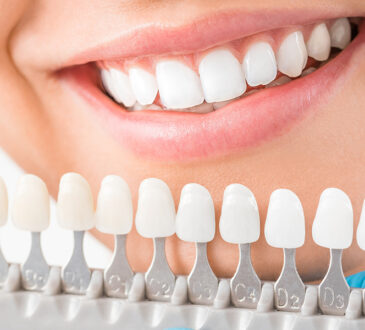 dental veneers