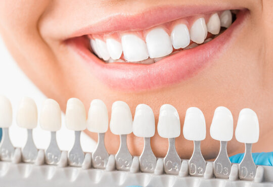 dental veneers