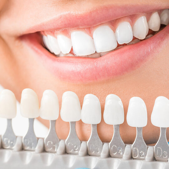 dental veneers