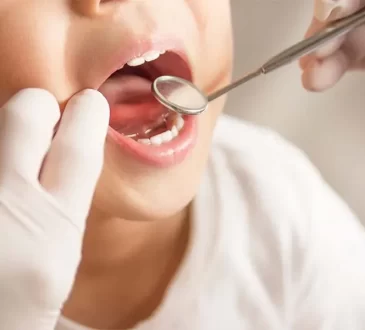 Dental Sealants