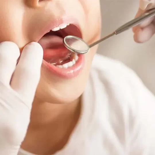 Dental Sealants