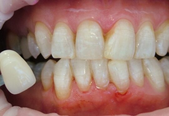 tooth yellowing