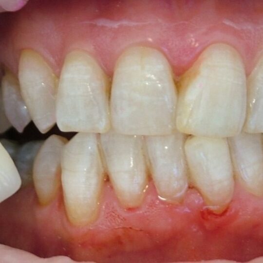 tooth yellowing
